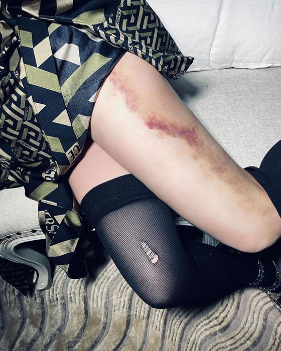 madonna-leg-bruise