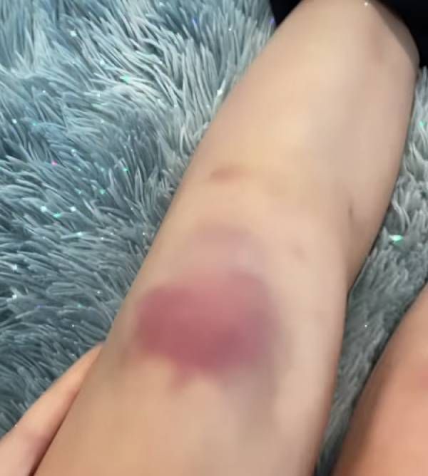 Legs on sex bruises GF has