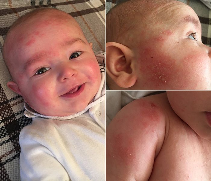Eczema In Children Real Mums Share Their Tips For Dealing With The Condition Hello