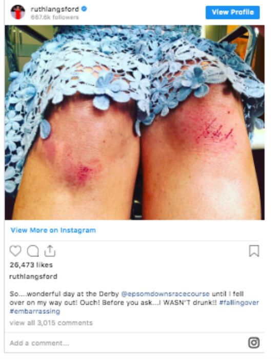 loose-women-ruth-langsford-injury
