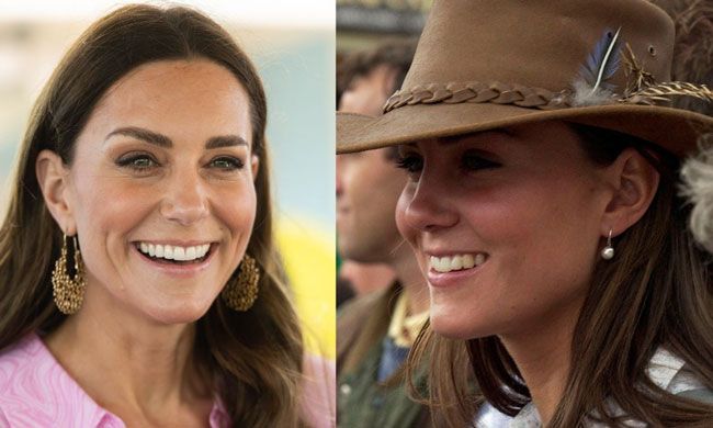 kate-middleton-teeth-before-and-after