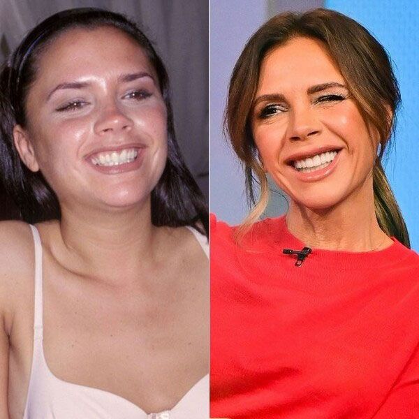 victoria-beckham-teeth-before-after