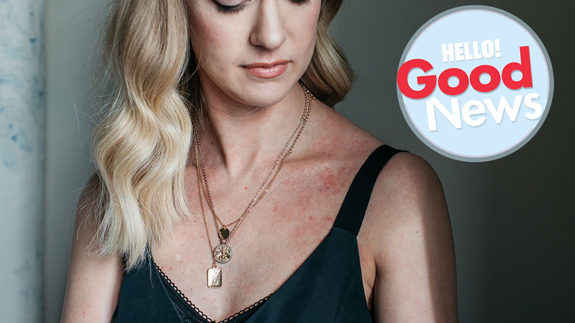 Skincare brand launches new ad campaign showing models with eczema